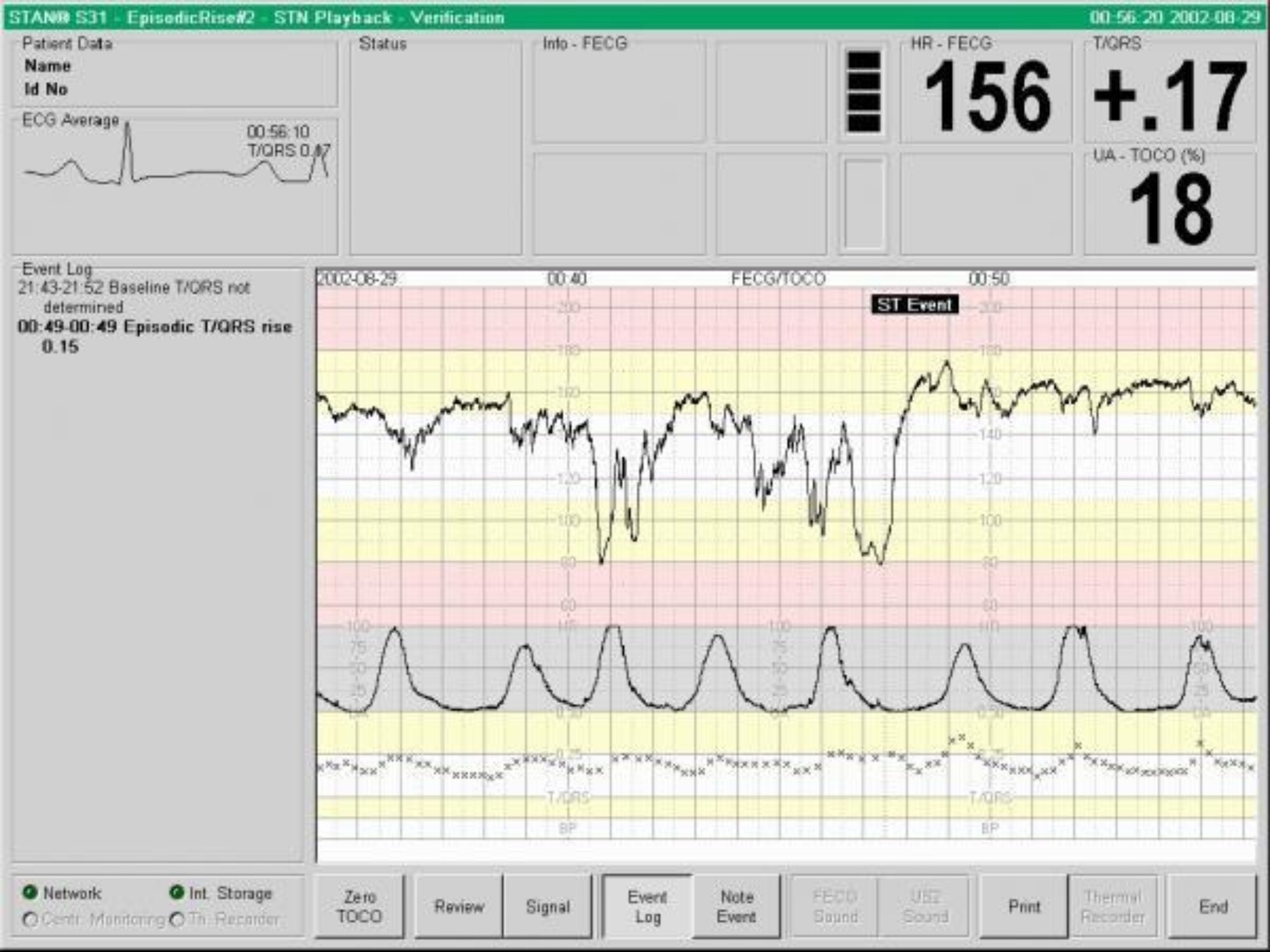 STAN : analyse du segment ST de l'ECG fœtal